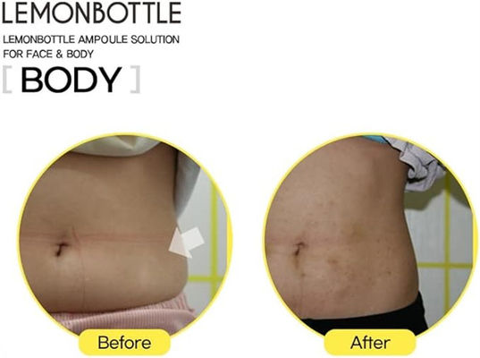 Ampoule Solution Fat Dissolving Injections 5 φιαλίδια X 10 ml μπουκάλι με λεμόνι για ενέσεις απώλειας βάρους